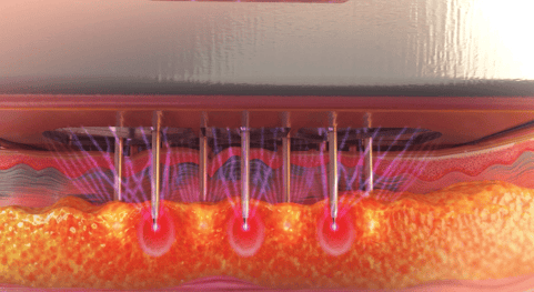 Illustration-of-radiofrequency-microneedling-depth-and-effect