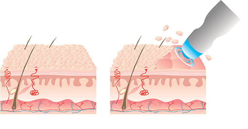 Microdermabrasion