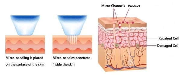 micro-needling-figure