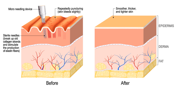 microneedling-illustration-1